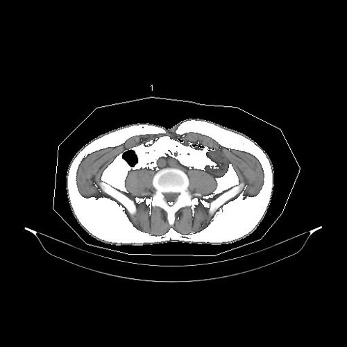 久津川医師の腹部CT図2
